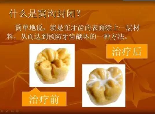 什麽(me) 是窩溝封閉