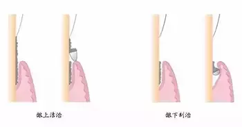 牙齦出血如何治療,牙齦出血怎麽(me) 辦
