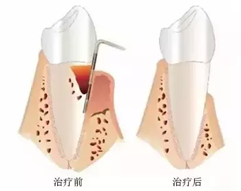 牙齦出血如何治療,牙齦出血怎麽(me) 辦