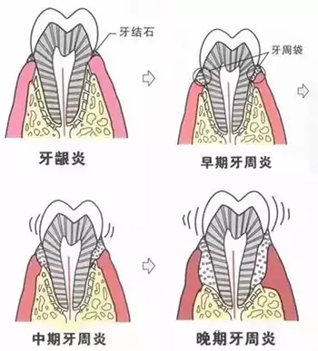 牙齦出血如何治療,牙齦出血怎麽(me) 辦