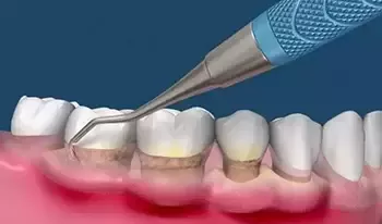 牙齦出血如何治療,牙齦出血怎麽(me) 辦