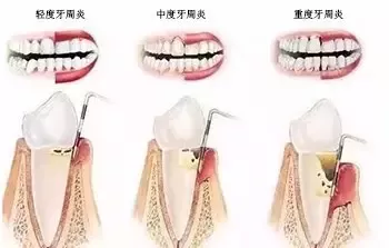牙齦出血如何治療,牙齦出血怎麽(me) 辦