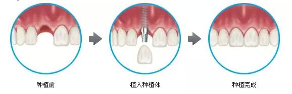 牙齒種植有什麽(me) 危害？