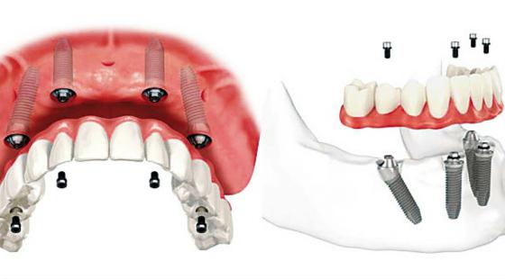 全口種植牙有哪些優(you) 點？