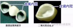 烤瓷牙的種類及價格！