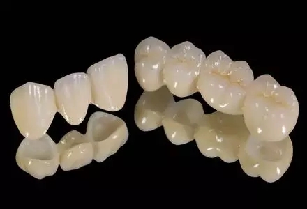 烤瓷牙的壽命有多長會(hui) 繃瓷掉瓷嗎