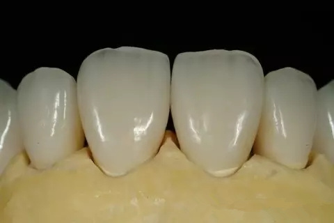 烤瓷牙也需要按時做體(ti) 檢