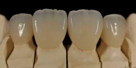 烤瓷牙也需要按時做體(ti) 檢