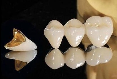 貴金屬烤瓷牙