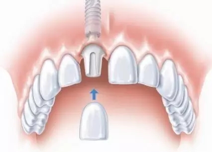 種植牙vs烤瓷牙
