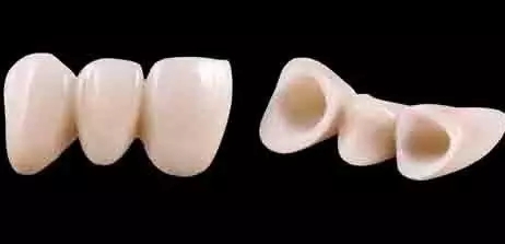 種植牙和烤瓷牙哪個(ge) 比較好？