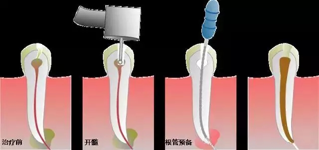 根管治療中的常見問題