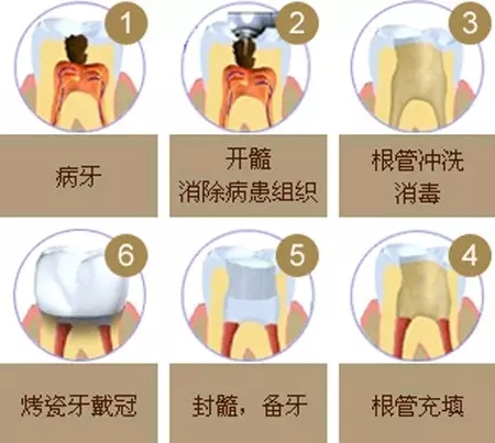 根管治療中的常見問題
