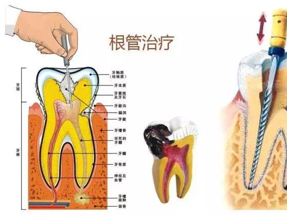根管治療真的是“抽牙神經”那麽(me) “藍瘦香菇”嗎?
