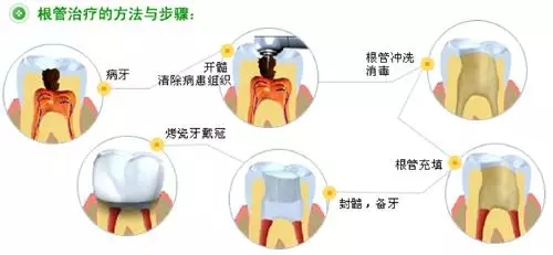 根管治療真的是“抽牙神經”那麽(me) “藍瘦香菇”嗎?