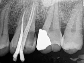 做了根管治療的牙齒是不是必須做烤瓷牙冠？
