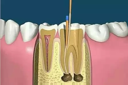 根管治療為(wei) 什麽(me) 會(hui) 那麽(me) 貴?