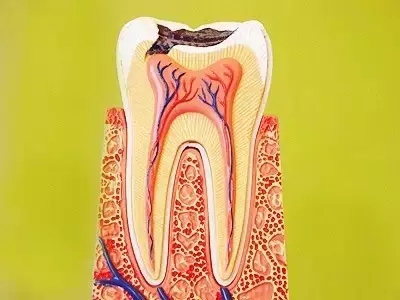 根管治療為(wei) 什麽(me) 會(hui) 那麽(me) 貴?