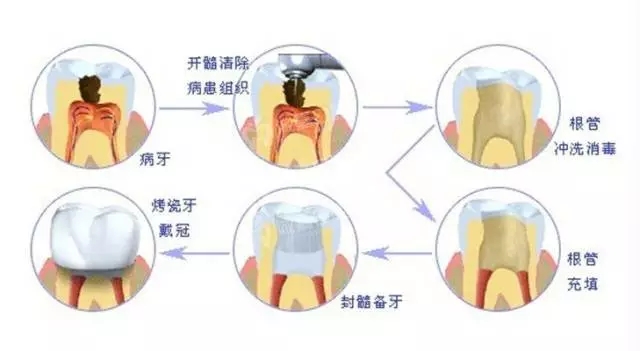 根管治療中疼痛的原因分析