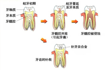 根管治療