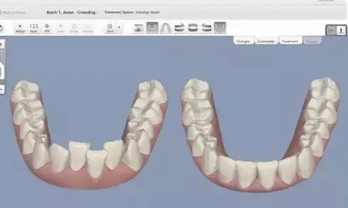 隱形矯正的程序