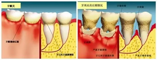 牙結石如何一步一步傷(shang) 害我們(men) 的牙齒的