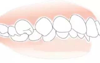 什麽(me) 才是正常的咬合？