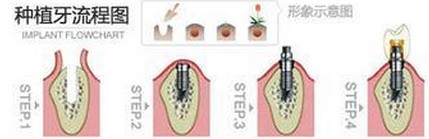 全口種植牙過程圖