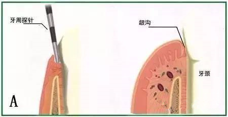 牙齦總是出血是怎麽(me) 回事？