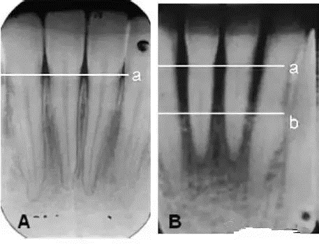 牙齦總是出血是怎麽(me) 回事？