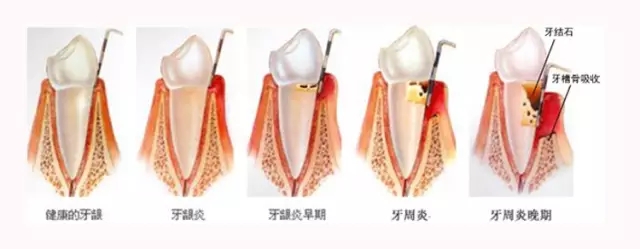 牙齦炎不是小毛病牙周炎的前奏