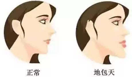 地包天矯正****圖