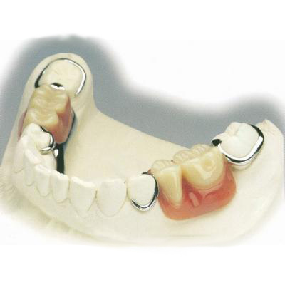 鑲牙的過程及較佳時間