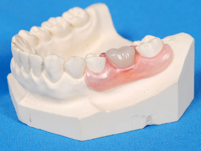 拔牙後多久可以鑲牙？