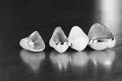 鎳鉻合金烤瓷牙