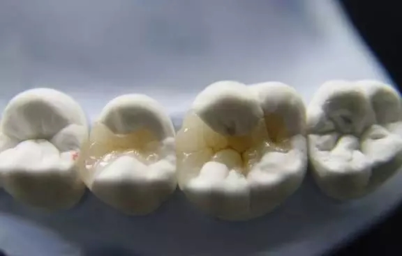 嵌體(ti) 修複與(yu) 充填修複的區別