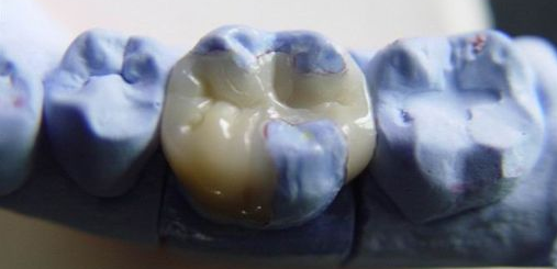 嵌體(ti) 牙好嗎