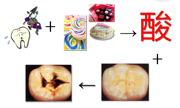 齲齒的早期臨(lin) 床症狀是什麽(me) ？