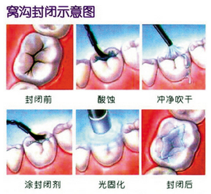 深圳窩溝封閉的害處？