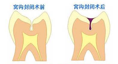 深圳兒(er) 童做窩溝封閉好不好？