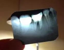 兒(er) 童牙齒矯正過程！