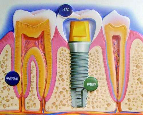 牙齒缺失種植牙