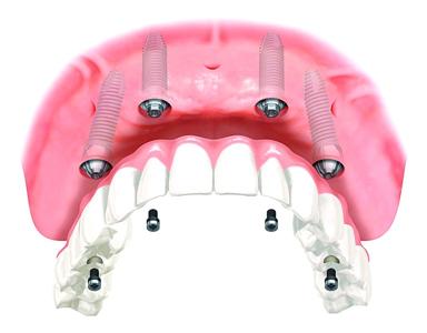 深圳半口牙缺失做種植牙選擇哪家醫院比較好？