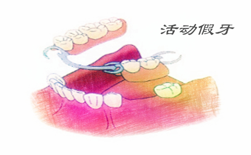 半口牙種植需要做幾次手術