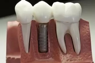 種植一顆門牙多少錢