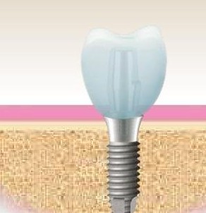 後牙種植牙修複需要多長時間