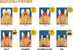 兒童齲齒引起的牙痛怎麽辦？