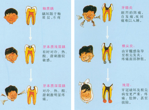  深圳兒(er) 童齲齒補一顆牙多少錢？