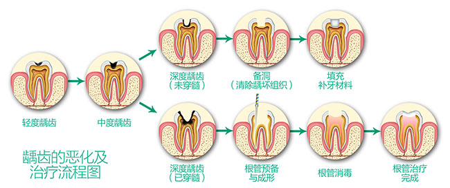  蟲牙是補牙好還是拔牙好？