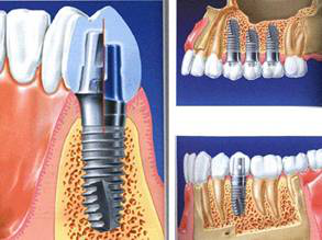深圳種植牙費用高嗎?